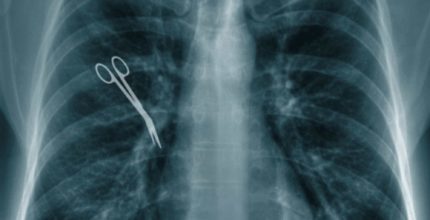 Retained object in xray of lungs