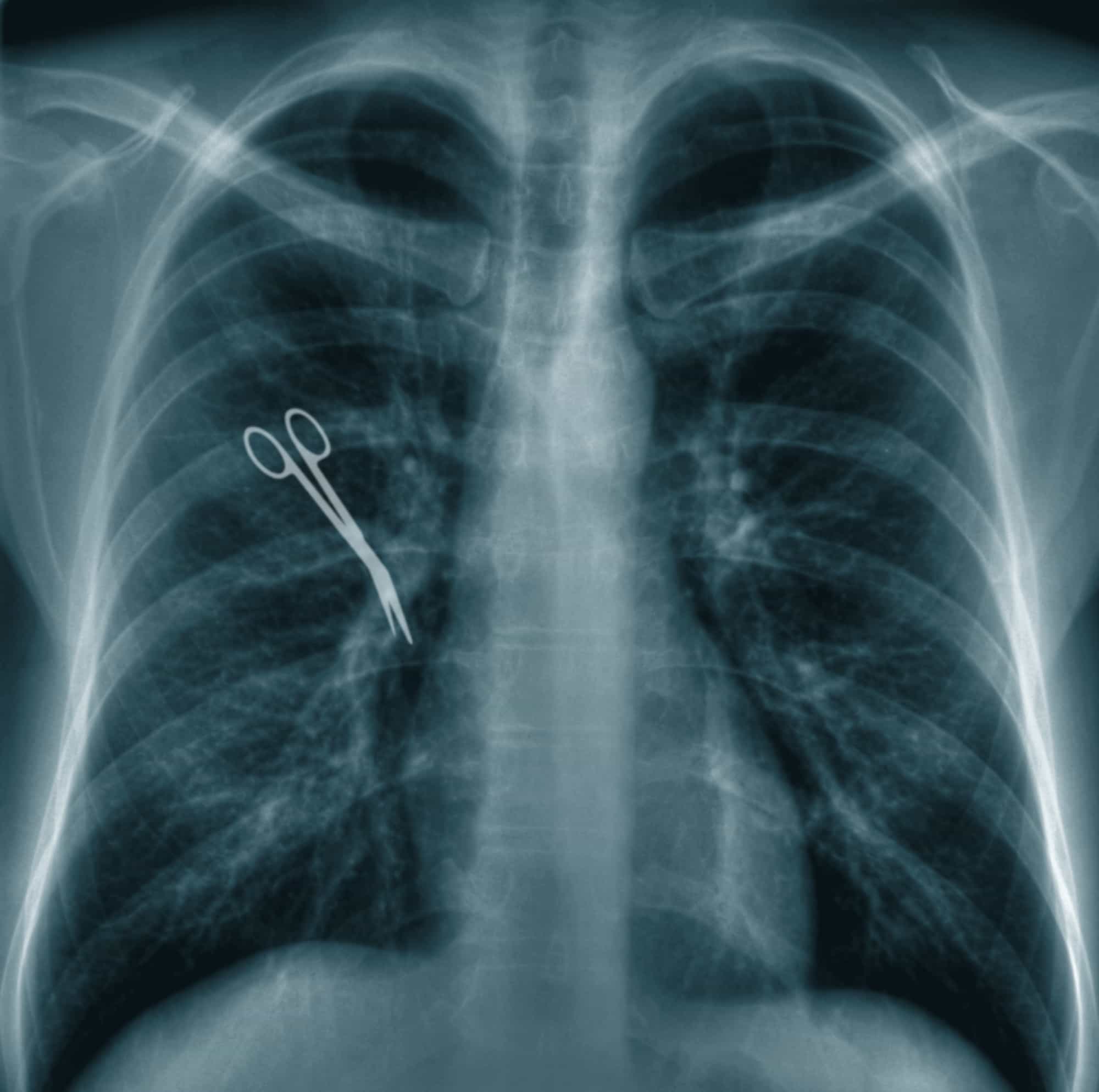 Retained object in xray of lungs