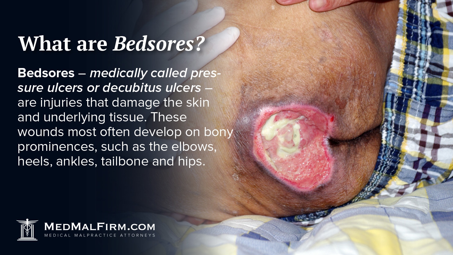 what are bedsores?