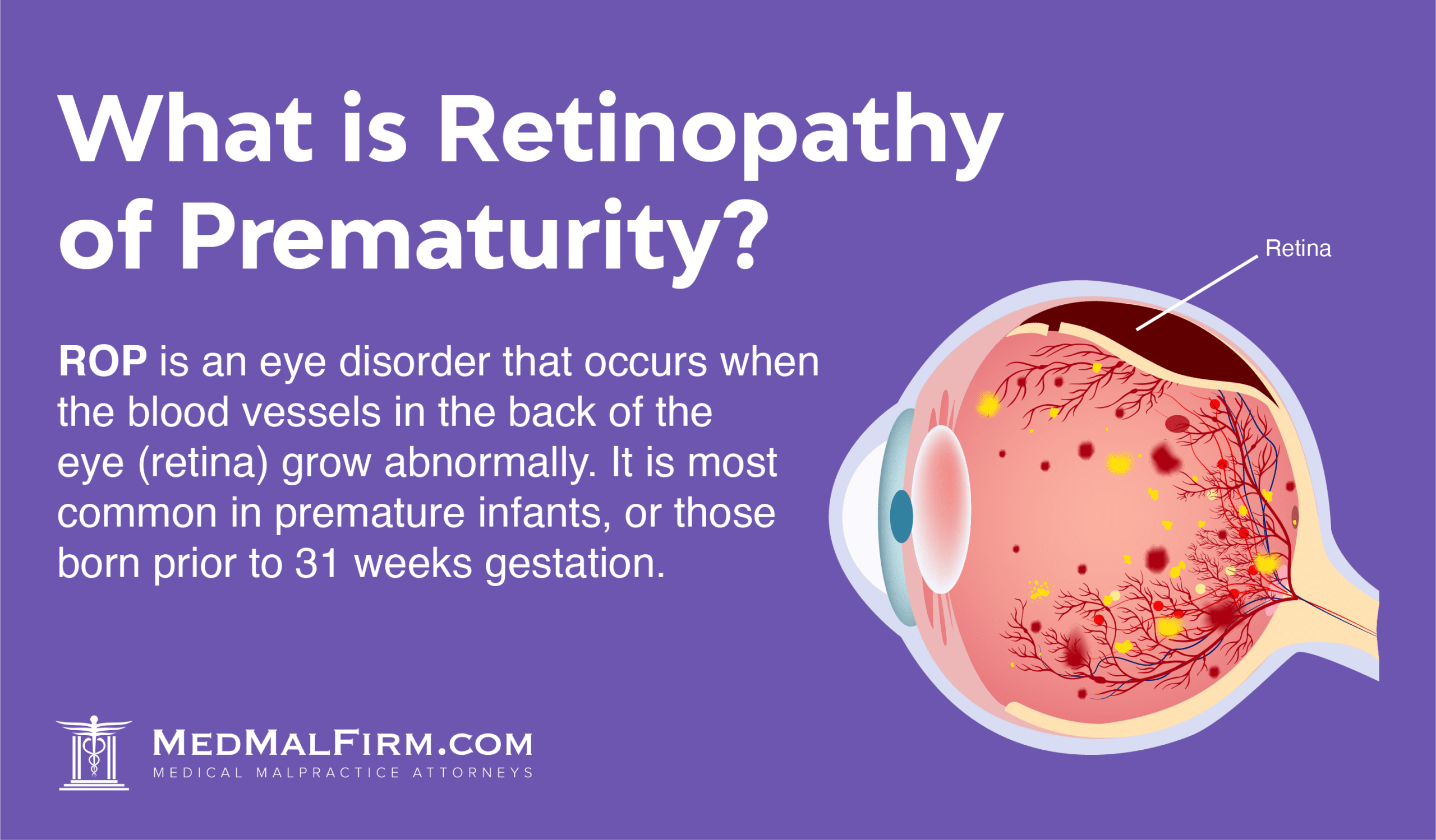 What is Retinopathy of Prematurity?