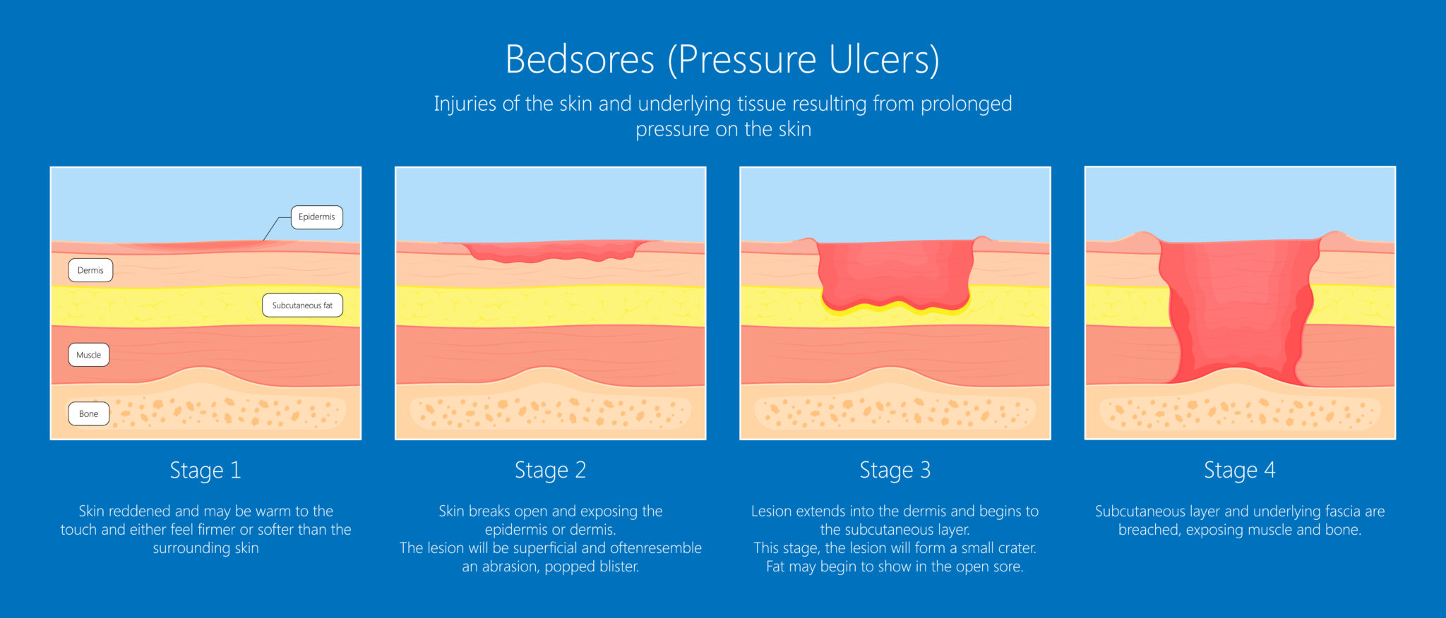 What are the Different Stages of Bedsores?