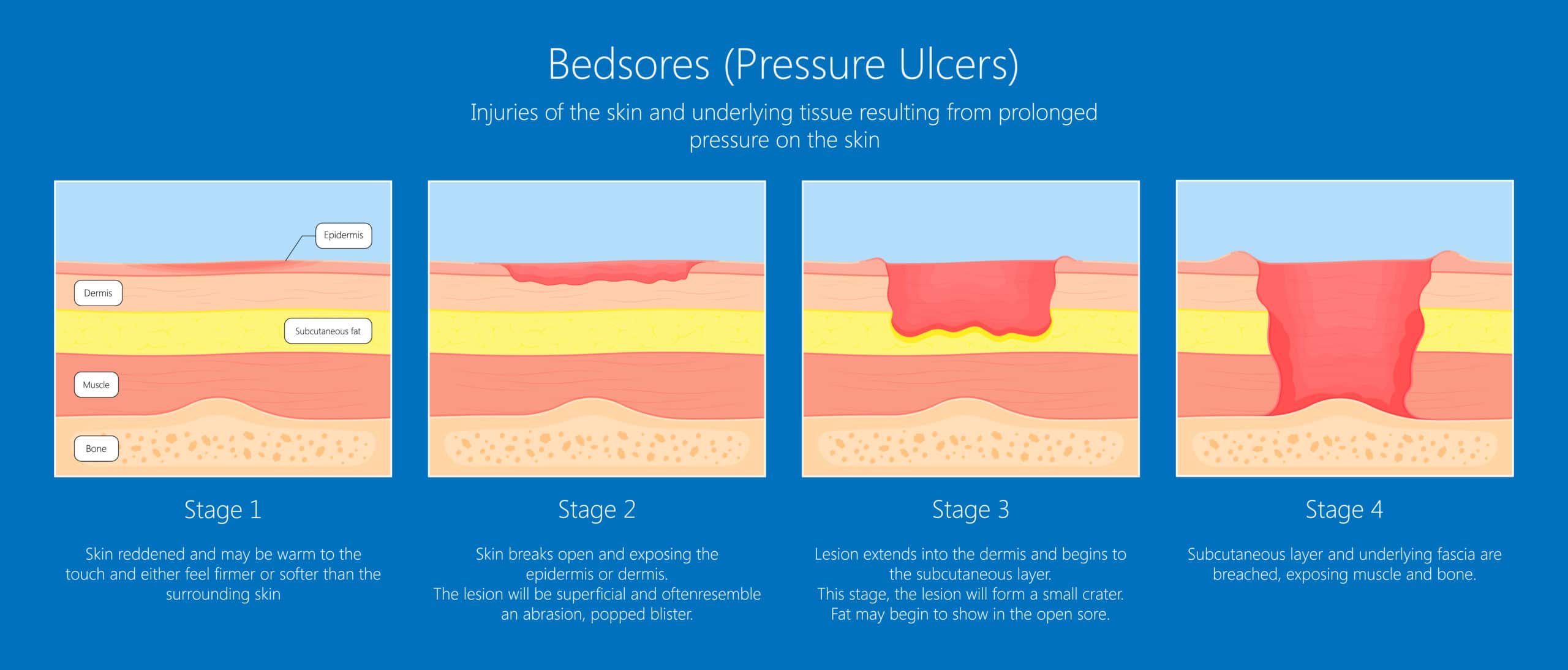 stages of bedsores, pressure ulcers