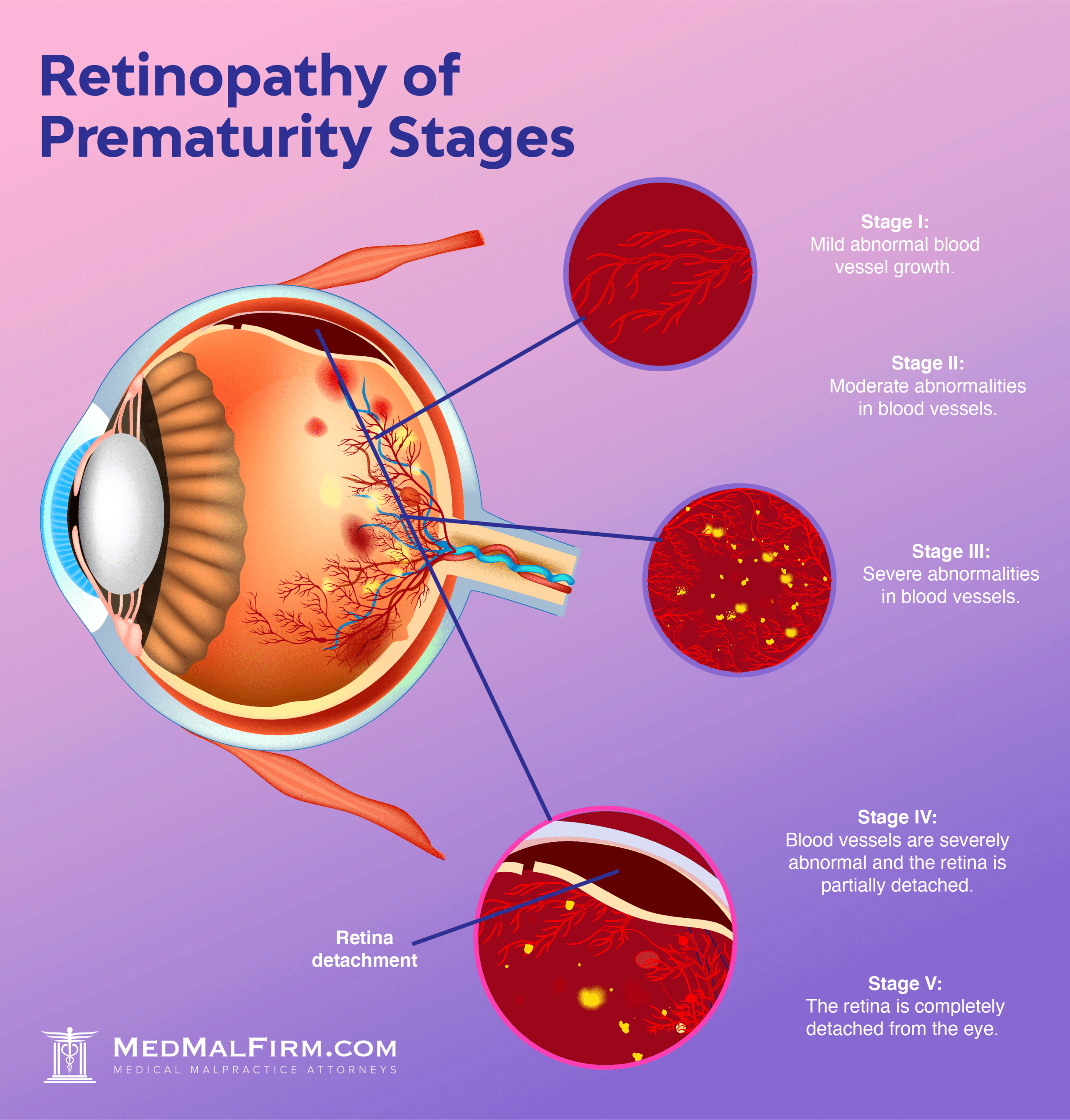 retinopathy of prematurity stages